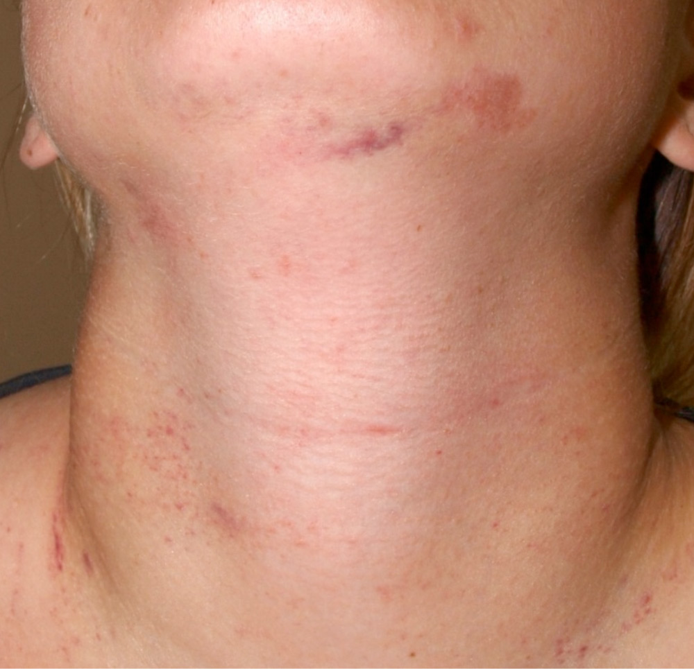 Abb. 14: Streifenförmige und kleinfleckige Unterblutungen am Hals und an der Kinnunterseite.