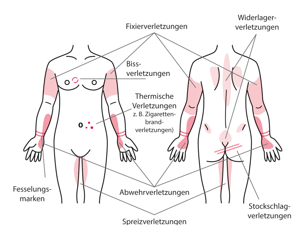 Abb. 15: Typische Verletzungenbei sexualisierter Gewalt (Zeichnung: K. Runge, Institut für Rechtsmedizin Greifswald)